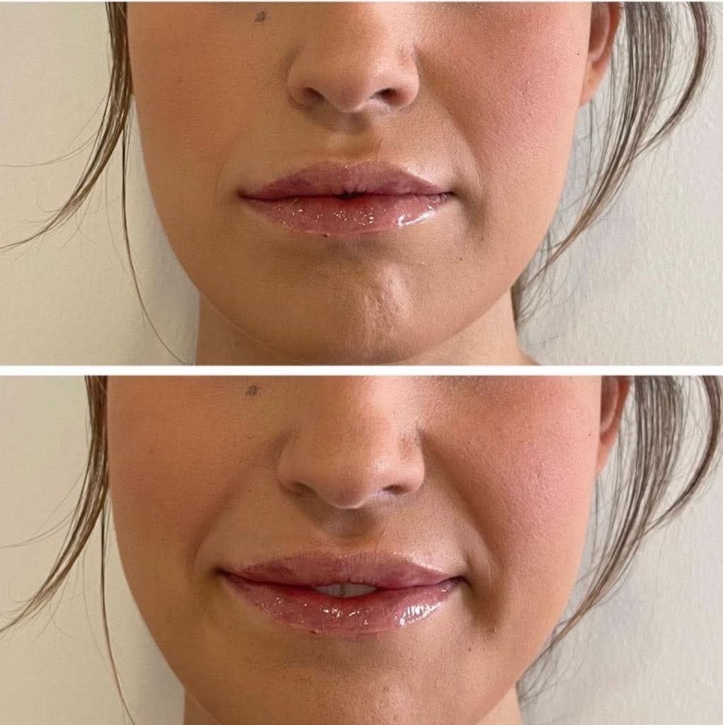 Dermal Fillers result — Lip Enhancement